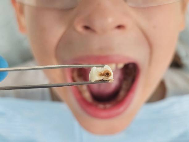 Best Emergency Dentist for Knocked-Out Tooth in Reese, MI